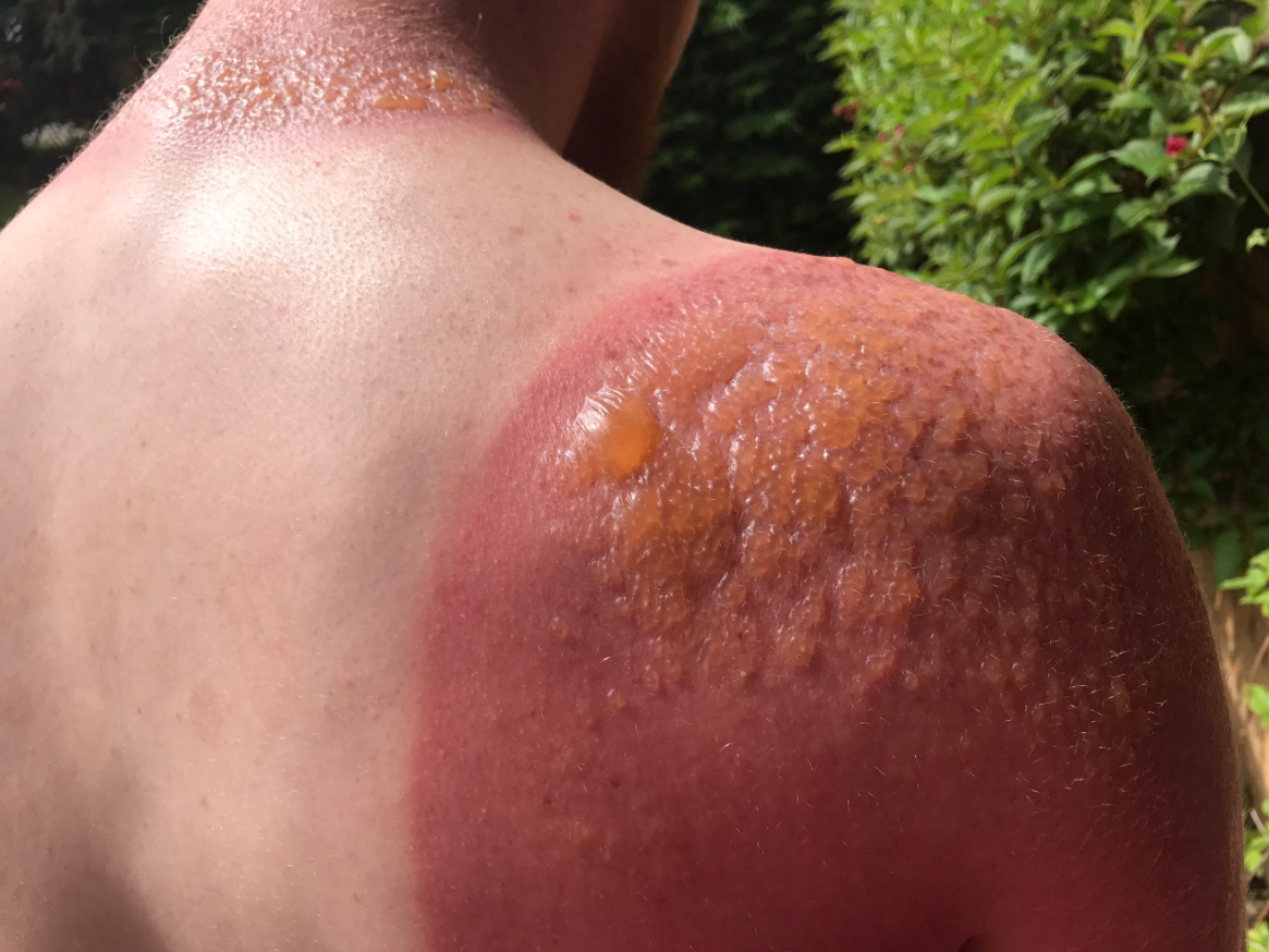 sunburn2.png